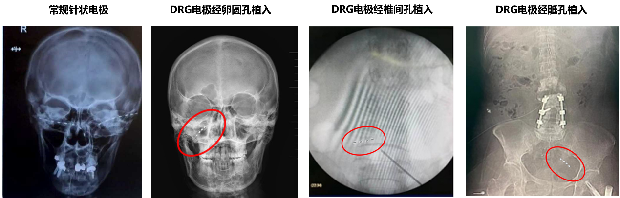 drg電極.png drg電極.png