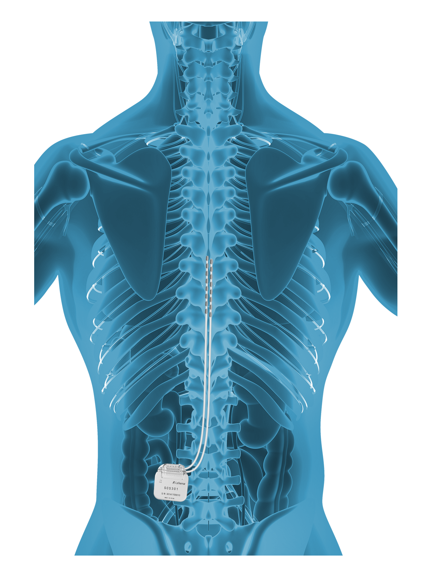 SCS療法.png SCS療法.png